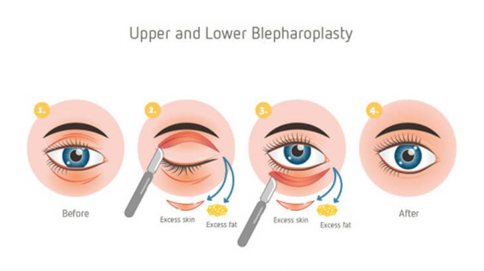 Eyelid surgery cost in Delhi - Dr Rajat Gupta