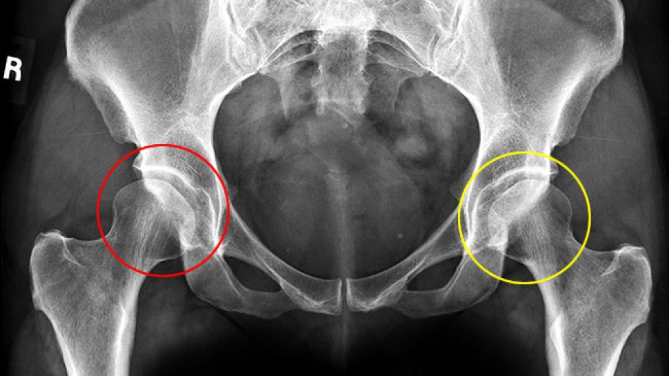 Hip Dysplasia in Babies